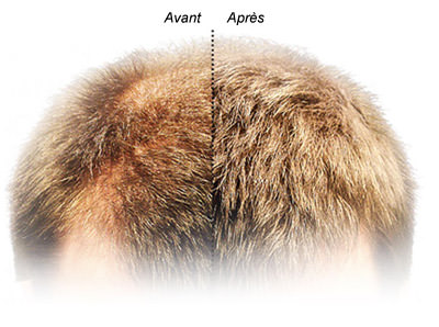 comment appliquer nanogen