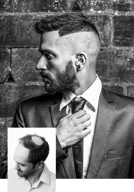 Oubliez votre perte de cheveux et retrouvez votre style grâce aux prothèses capillaires Hairfax