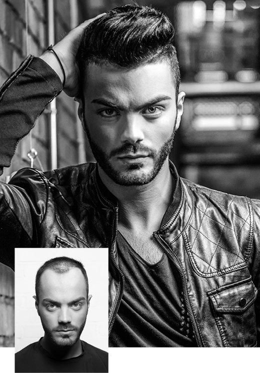 Corrigez votre calvitie et retrouvez vos cheveux grâce au spécialiste du remplacement capillaire Hairfax